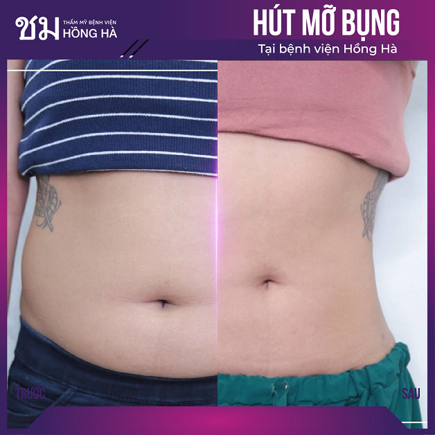 Chú ý vệ sinh vết thương sau hút mỡ sạch sẽ để đảm bảo kết quả tối ưu