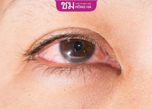 10 cách khắc phục tình trạng mí mắt bị sưng sau khi ngủ dậy