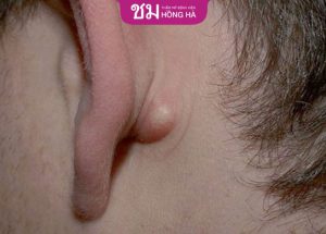 Mụn bã đậu có nguy hiểm không? Phương pháp điều trị hiệu quả