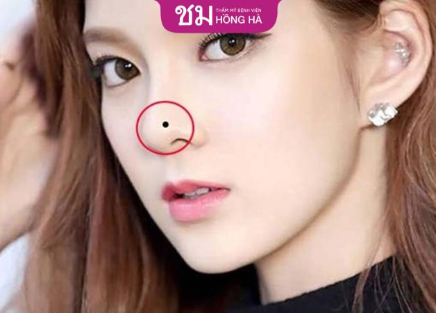 Nếu nốt ruồi ảnh hưởng đến thẩm mỹ thì nên tẩy