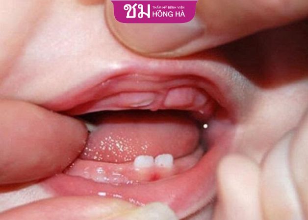 Nên tránh sử dụng các tác nhân gây tê khi trẻ mọc răng để đảm bảo an toàn cho bé