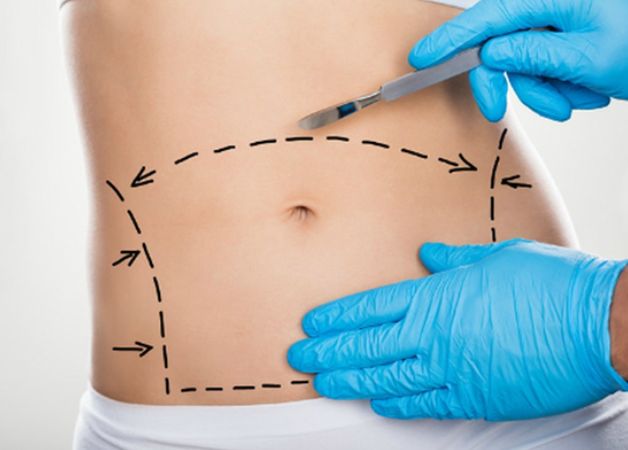 Công nghệ hút mỡ hiện đại giúp giảm cân cấp tốc
