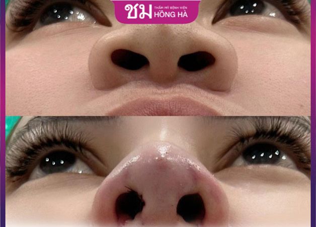 Cắt cánh mũi không để lại sẹo tại Thẩm mỹ Bệnh viện Hồng Hà