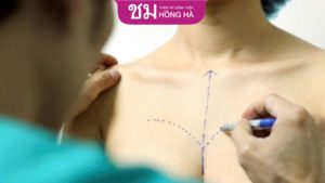 Cắt ngực chuyển giới có ảnh hưởng gì không –  Cách kiểm soát