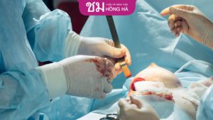 Cắt ngực có đau không – Cách giảm đau sau cắt ngực chuyển giới