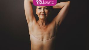 Chi phí phẫu thuật thu nhỏ vòng 1: 5 Yếu tố ảnh hưởng