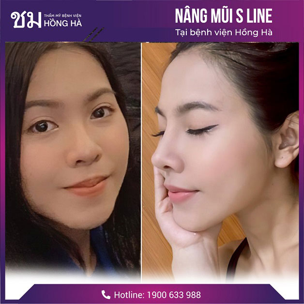Yếu tố quyết định đến tính an toàn khi nâng mũi là địa chỉ thực hiện