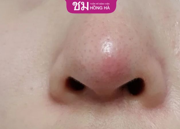 1 tháng sau nâng mũi vẫn bị đỏ đầu mũi bạn nên thăm khám bác sĩ ngay
