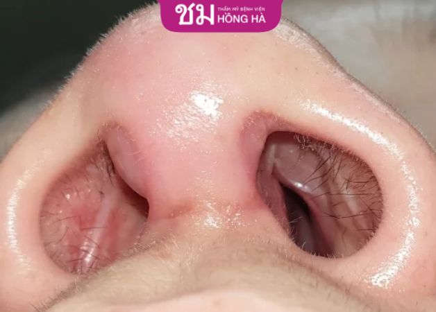 Với tình trạng đầu mũi bị đỏ nhiều cần đến sự hỗ trợ từ bác sĩ