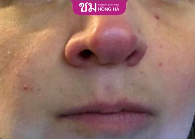 Nâng mũi bọc sụn vẫn bị đỏ đầu mũi là hiện tượng phổ biến