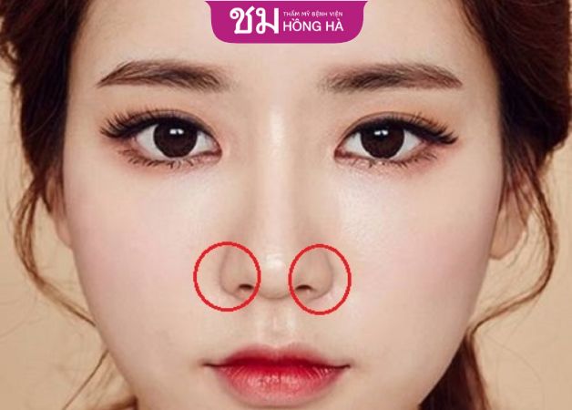 Phẫu thuật cắt cánh mũi không làm ảnh hưởng đến tướng số
