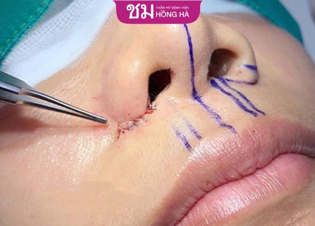 Bác sĩ thực hiện cắt cánh mũi