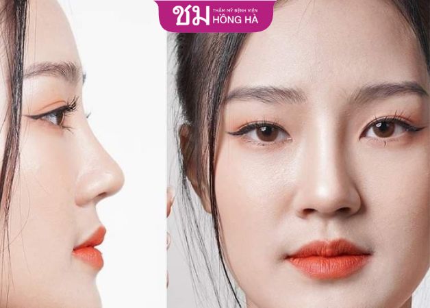 Cắt cánh mũi không làm cho mũi cao hơn