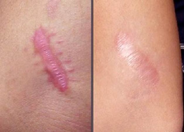 Thẩm mỹ điều trị sẹo lồi có thể khỏi sau 1-3 tháng