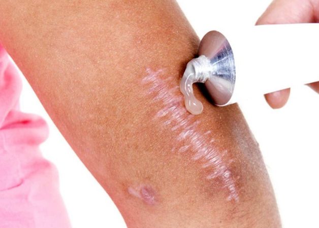 Sử dụng kem bôi trị sẹo