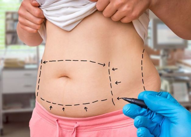Hút mỡ giảm cân nhanh chóng