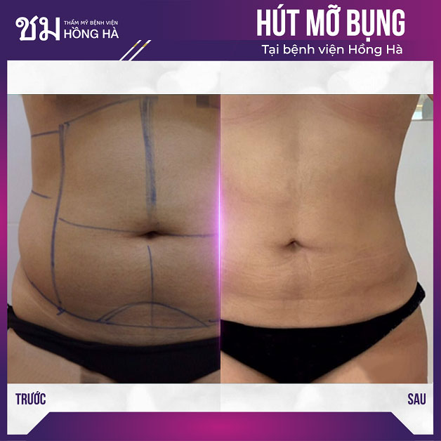 Công nghệ hút mỡ nội soi Thai Hi-Lipo giúp loại bỏ mỡ thừa nhanh chóng
