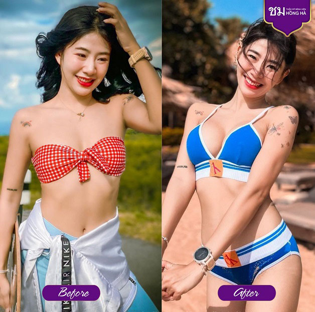 Kết quả của khách hàng sau khi thực hiện phẫu thuật nâng ngực tại Thẩm mỹ Bệnh viện Hồng Hà