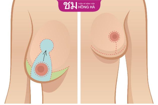 Treo ngực sa trễ phù hợp với chị em có vòng 1 chảy sệ sau sinh