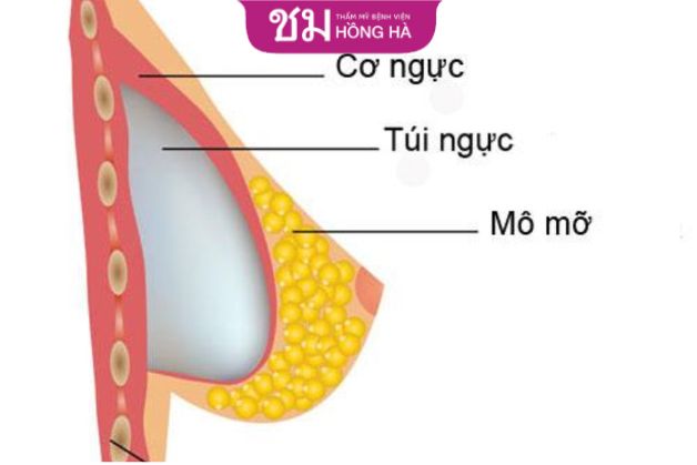 Phương pháp nâng ngực đặt túi độn giúp cải thiện vòng 1