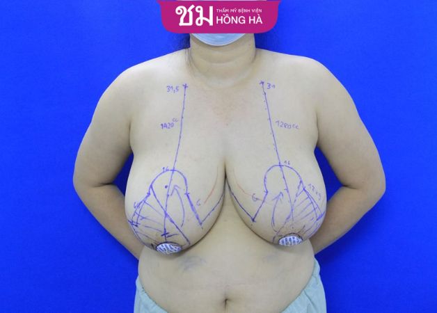 Kích thước ngực quá khổ gây xệ