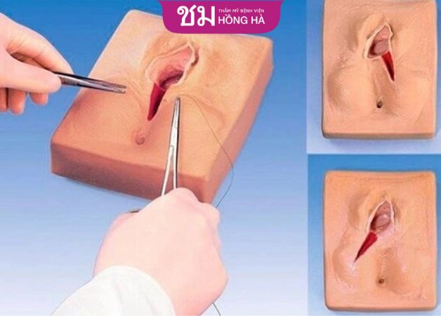 Công nghệ cắt môi bé tiêu chuẩn Thái Lan