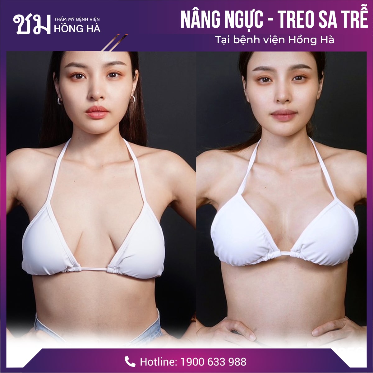 Phẫu thuật ngực là giải pháp khắc phục chảy xệ ngực hiệu quả nhất