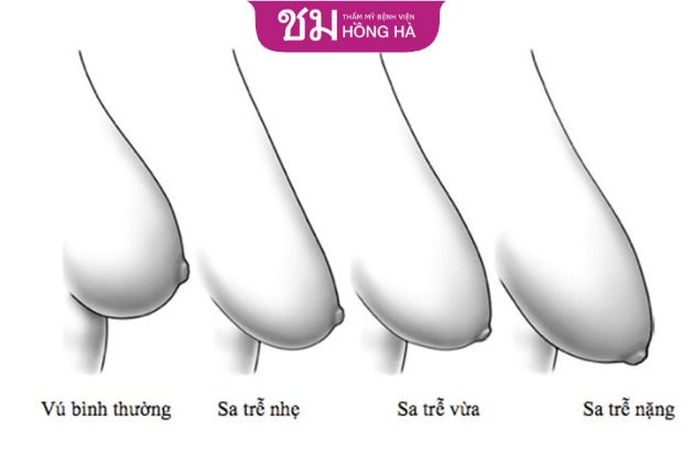 Các cấp độ sa trễ ngực