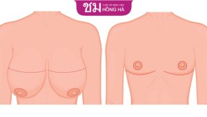 Phẫu thuật cắt bỏ ngực cho les và tất cả những điều bạn cần biết