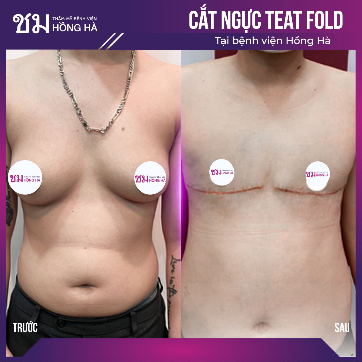Phương pháp cắt ngực Teat - Fold
