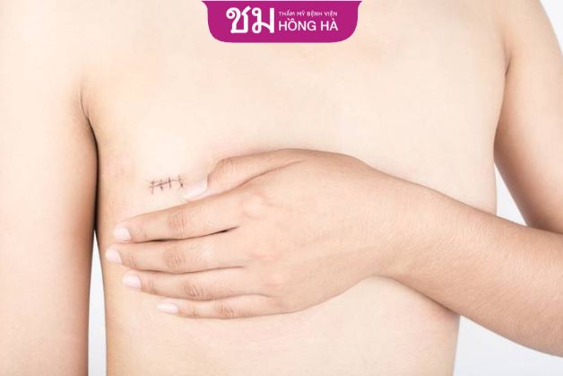 Phẫu thuật cắt ngực chuyển giới có thể gây ra một số ảnh hưởng