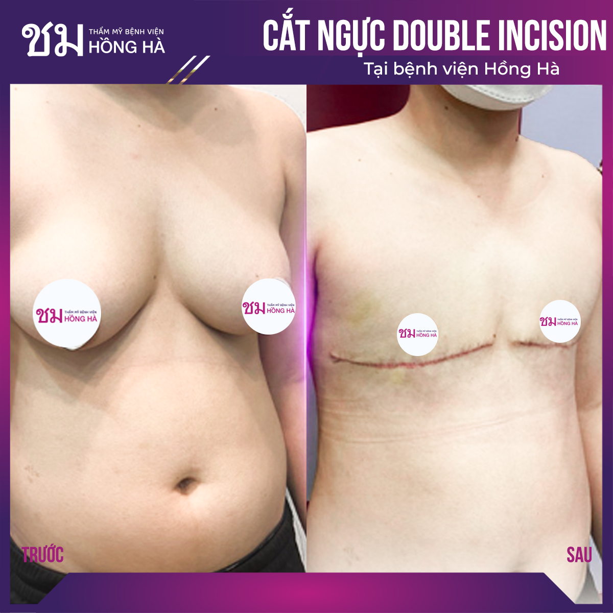 Phẫu thuật Double Incision cắt ngực cho les