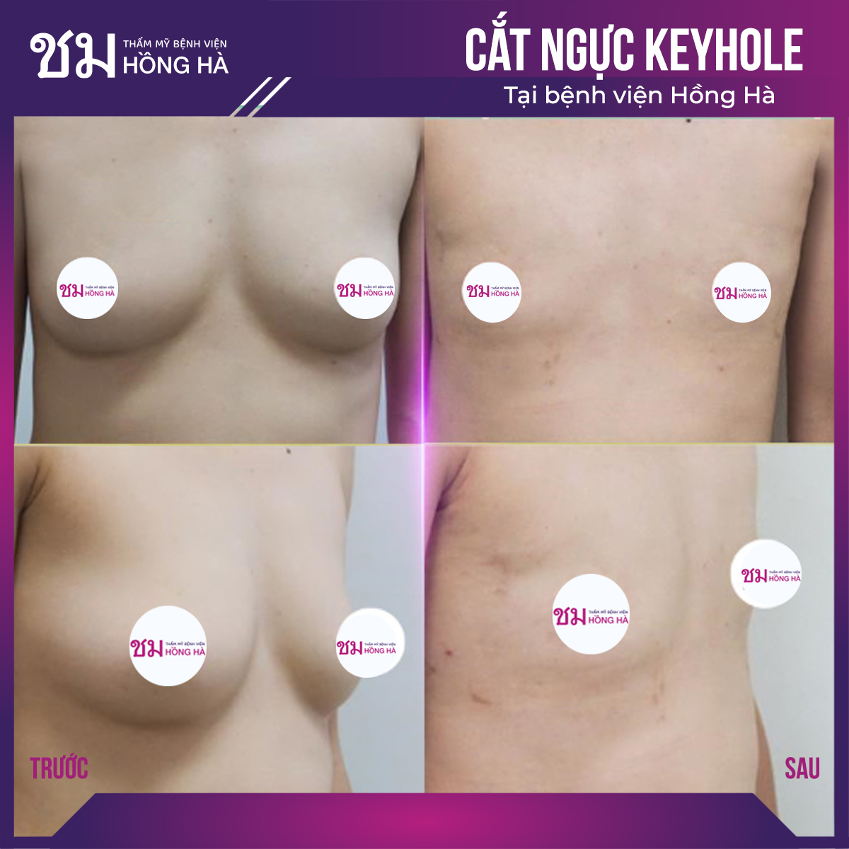 Cắt ngực bằng phương pháp Keyhole