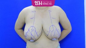 Thu gọn ngực phì đại giá bao nhiêu? Cảnh báo thu gọn ngực giá rẻ