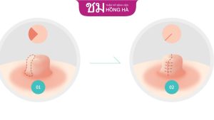 Phương pháp thu nhỏ đầu vú là gì? Có nguy hiểm không?