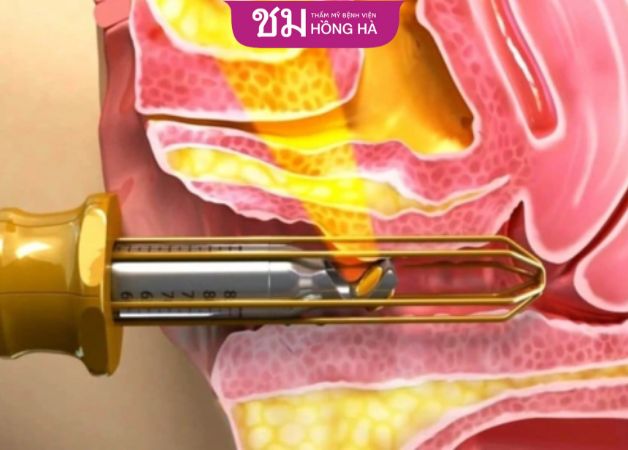 Phương pháp thu nhỏ âm đạo bằng laser