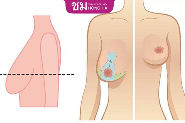 Treo ngực sa trễ được bao lâu
