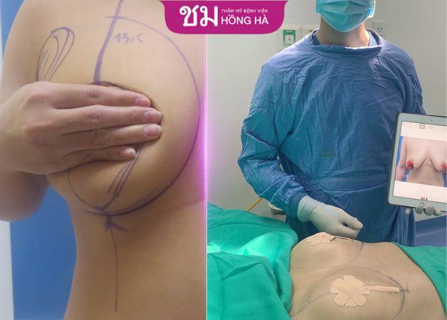 Vòng 1 săn chắc và gọn gàng hơn ngay sau khi thực hiện