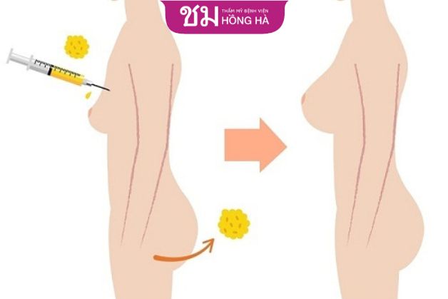 Treo sa trễ ngực không đặt túi bằng mỡ tự thân