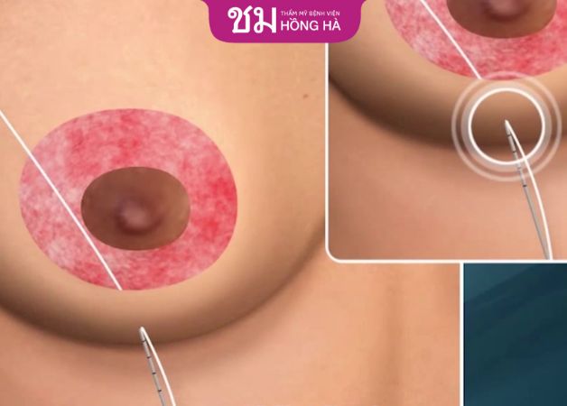 Treo sa trễ ngực không đặt túi bằng chỉ