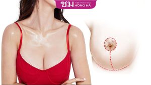 2 Cách thu nhỏ quầng vú hiệu quả và địa chỉ uy tín