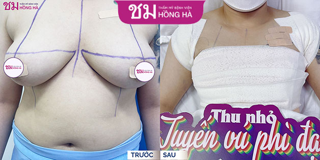 Hình ảnh khách hàng trước và sau khi phẫu thuật ngực phì đại tại Thẩm mỹ Bệnh viện Hồng Hà