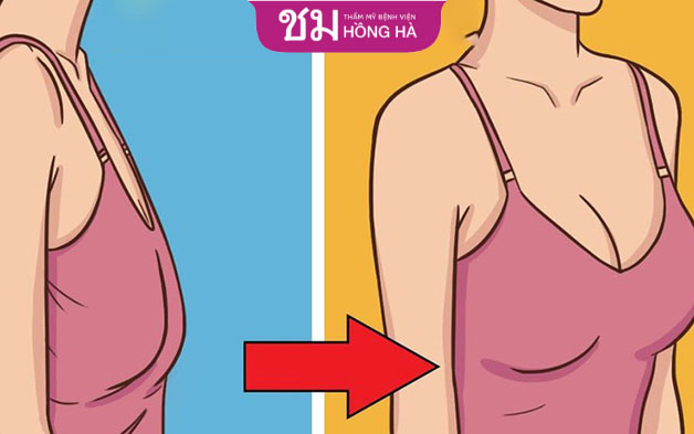 Nâng ngực chảy xệ tại cơ sở uy tín không hề nguy hiểm đến sức khỏe