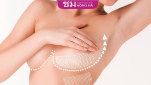 Nâng ngực chảy xệ có nguy hiểm không? Cách ngăn ngừa hiệu quả