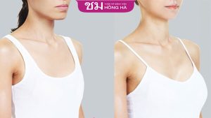 Phương pháp nâng ngực không phẫu thuật có hiệu quả không