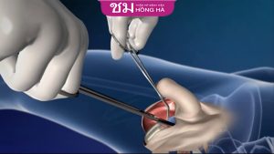 Phẫu thuật chuyển giới bộ phận sinh dục nam: lưu ý điều gì