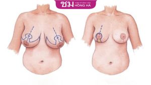 Phẫu thuật ngực phì đại có nguy hiểm không? Bí quyết giúp giảm tiểu tổn thương