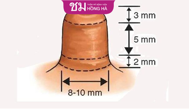 Người có tình trạng đầu ti phì đại mong muốn thực hiện phẫu thuật