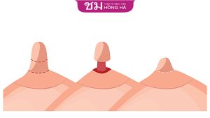 Phẫu thuật thu gọn đầu vú – Những lưu ý sau khi phẫu thuật