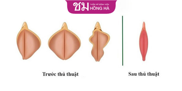 Tùy vào tình trạng môi lớn, bác sĩ sẽ có cắt và loại bỏ đi những phần mô chùng nhão